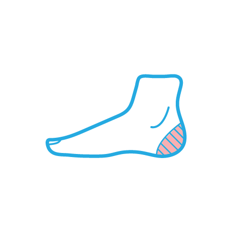 диабетическая стопа