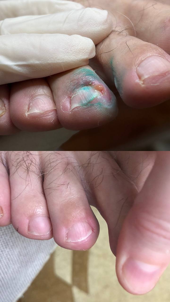 вросший_ноготь