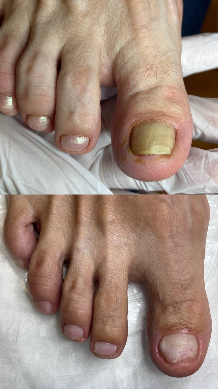 грибковая_инфекция